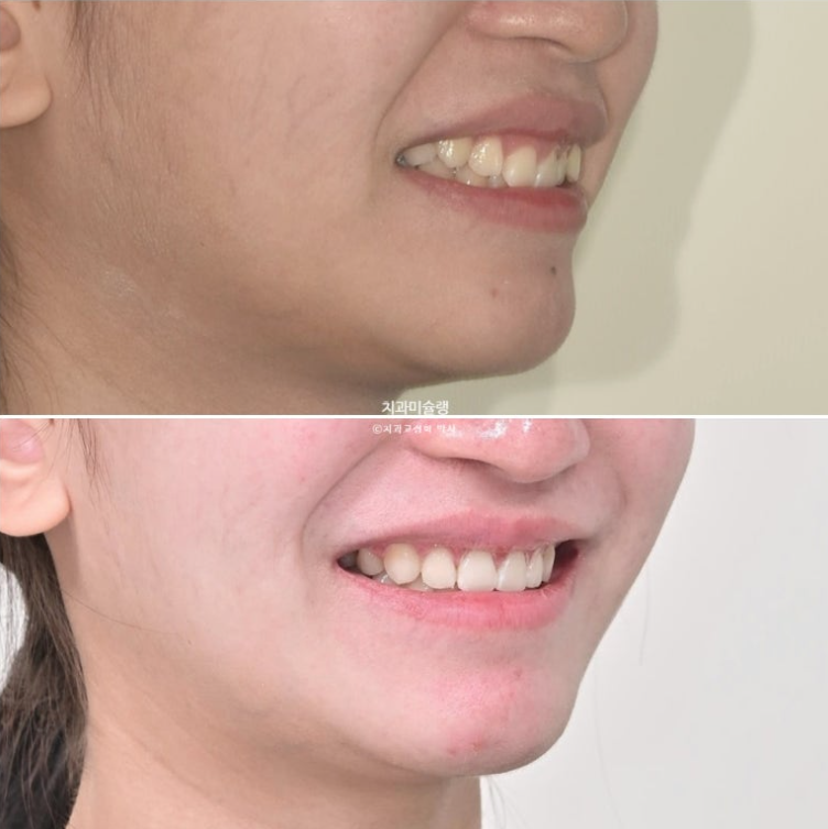 잇몸미소 거미스마일 치료 옥니 교정 잇몸성형 후기 관련 이미지 1