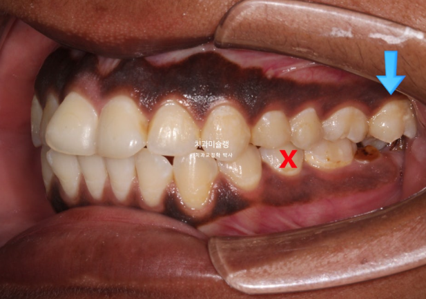 Extraction & re-orthodontics with Clippy-C, intrusion for dental implant. 관련 이미지 7