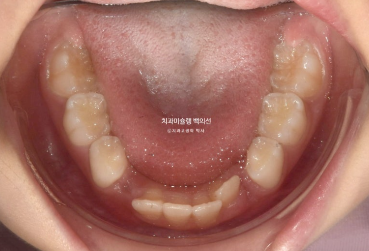 어린이 무턱 성장교정 덧니 인비절라인 퍼스트 악궁확장 치료기간 2년 관련 이미지 5