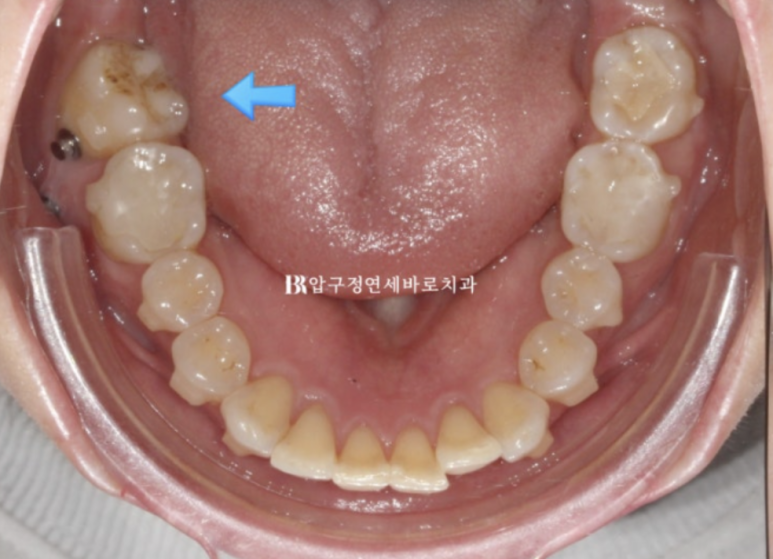 40대 인비절라인 라이트 가위교합, 과개교합까지 10개월 교정 증례 관련 이미지 9