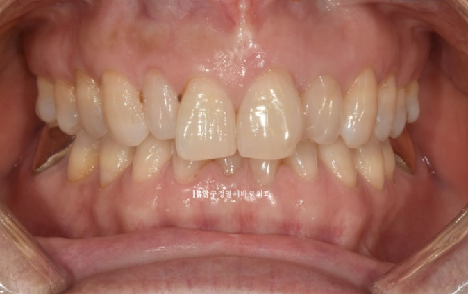 Can It Be Done in Your 50s? Real Results from Limited Front Teeth Orthodontics + No-Prep Laminate Veneers Revealed image 2
