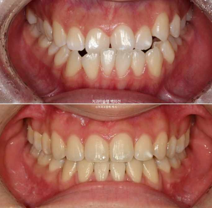 비수술 주걱턱 비대칭 발치 교정 결손치 반대교합 클리피씨 치료기간 1년 11개월 관련 이미지 1