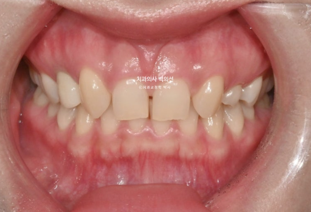 앞니 선천적 결손 벌어짐 잔존 유치 무삭제 라미네이트 관련 이미지 2