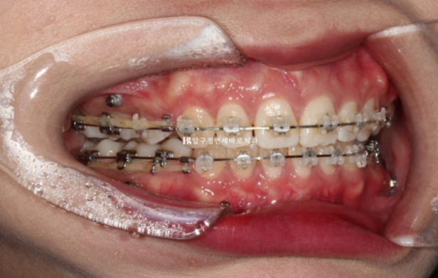 돌출입 교정 입동굴 클리피씨 교정 후기 관련 이미지 8