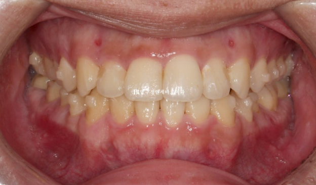 양악수술 교정 인비절라인 주걱턱 교정 치료 후기 관련 이미지 7