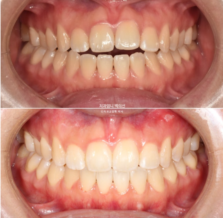 앞니 단기 부분교정 재교정 개방교합 교정 후기 관련 이미지 1