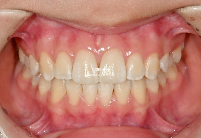 돌출입 비발치 어린이 교정 입술부전증 호두주름 호두턱 토끼이빨 인비절라인퍼스트 관련 이미지 14