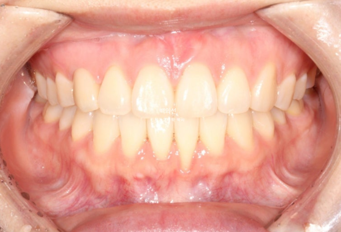 매복 결손 잔존유치 라미네이트 크라운 캔팅 인비절라인 라이트 치료 관련 이미지 16