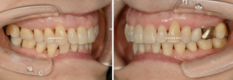 50대 치아교정 중년 발치교정 블랙트라이앵글 치료 후기 관련 이미지 13