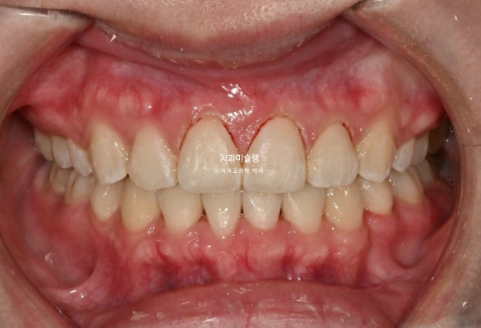 잇몸미소 거미스마일 치료 옥니 교정 잇몸성형 후기 관련 이미지 13