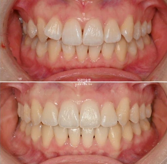 덧니 인비절라인 라이트 잇몸미소 거미스마일 중심선 블랙트라이앵글 관련 이미지 16