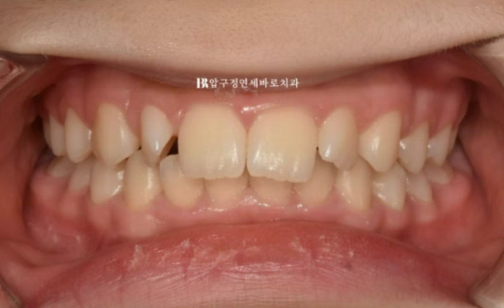 서울 인비절라인 덧니 교정 과개교합 후기 관련 이미지 1