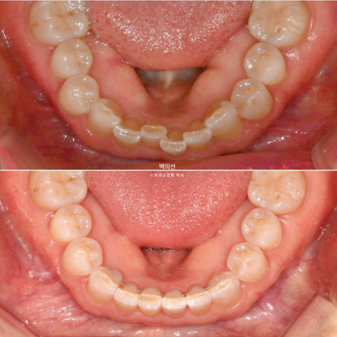 50대 치아교정 :: 인비절라인 익스프레스 치아 벌어짐 단기교정 후기 관련 이미지 18
