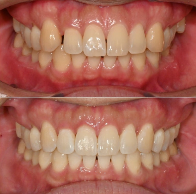 가위교합 벌어짐 중심선 과개교합 인비절라인 라이트 교정 관련 이미지 16