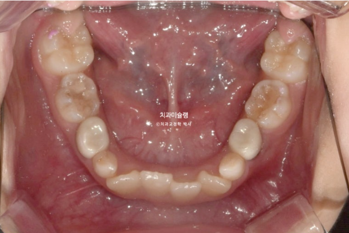 어린이 투명교정 인비절라인 퍼스트 과개교합 교정 후기 관련 이미지 5