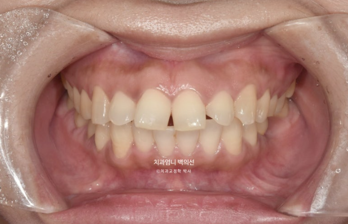 40대 인비절라인 라이트 앞니 벌어짐 뻗침 돌출 치료 관련 이미지 2