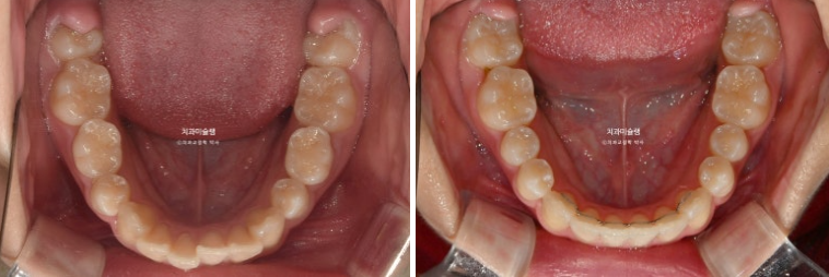 돌출입 비발치 어린이 교정 입술부전증 호두주름 호두턱 토끼이빨 인비절라인퍼스트 관련 이미지 17