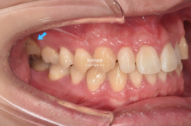 비대칭 비발치 거미스마일 잇몸미소 중심선 가위교합치료 무삭제 라미네이트 관련 이미지 4