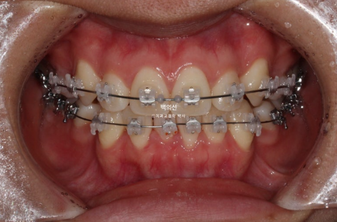 덧니 발치교정 클리피씨 입매 부작용 인중 입술 잇몸 퇴축 관련 이미지 8
