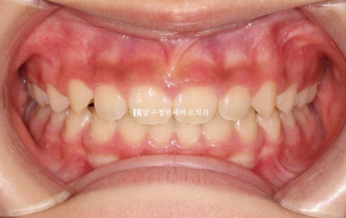 Pediatric Clear Aligners That Improved Both Deep Bite and Protruding Teeth image 13