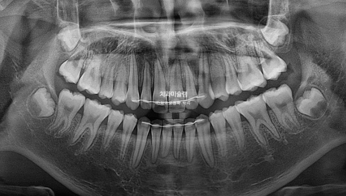 돌출입 비발치 어린이 교정 입술부전증 호두주름 호두턱 토끼이빨 인비절라인퍼스트 관련 이미지 24