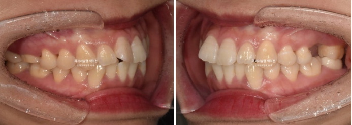 인비절라인 돌출입 발치교정 임플란트 없이 사랑니 대체 관련 이미지 3