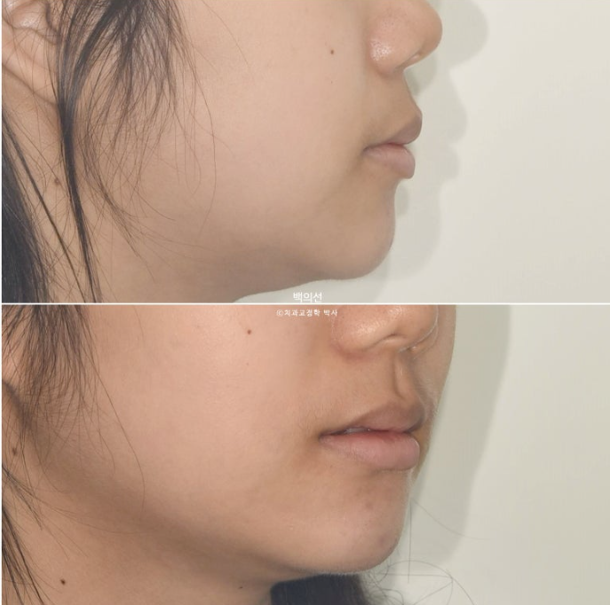 덧니 발치교정 클리피씨 입매 부작용 인중 입술 잇몸 퇴축 관련 이미지 7