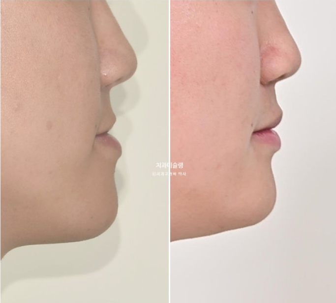 비수술 비발치 주걱턱 절충치료 클리피씨 개방교합 반대교합 치료 관련 이미지 19
