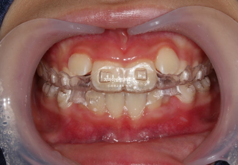 어린이 무턱 성장교정 덧니 인비절라인 퍼스트 악궁확장 치료기간 2년 관련 이미지 9