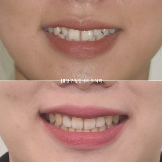 왜소치 인비절라인 라이트 교정 / 무삭제 라미네이트 젤라미 관련 이미지 12