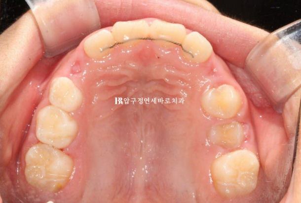 Invisalign First Correction for a Retruded Chin in a Child Orthodontic Treatment for Protrusion image 18