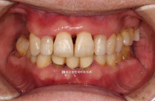A 60s Patient’s Orthodontic Treatment Review | A Case Combining Partial Orthodontics for the Front Teeth After Periodontitis Treatment with No-Prep Veneers image 5