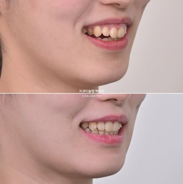 잇몸미소 인비절라인 거미스마일 토끼이빨 교정 무삭제 라미네이트 반대교합 치료 후기 관련 이미지 12