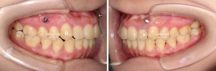 잇몸미소 인비절라인 거미스마일 토끼이빨 교정 무삭제 라미네이트 반대교합 치료 후기 관련 이미지 9