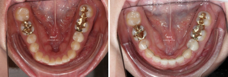 30대 치아교정 돌출입 교정 :: 잇몸미소 거미스마일 교정 입술부전증 결손치 무턱교정 관련 이미지 17