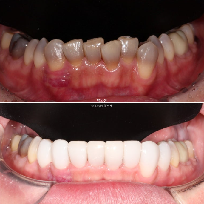 Treatment Review: No-Prep Laminate for Tetracycline-Stained Teeth image 1
