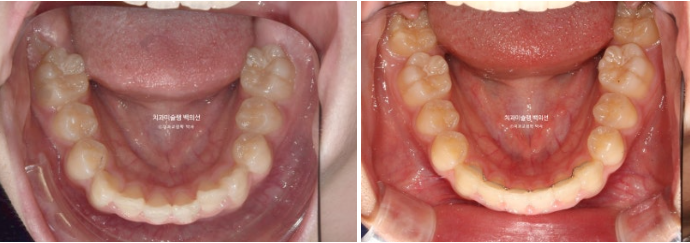 덧니 돌출입 발치교정 상악만 2개 편악 발치 클리피씨 입술부전증 치료 관련 이미지 13