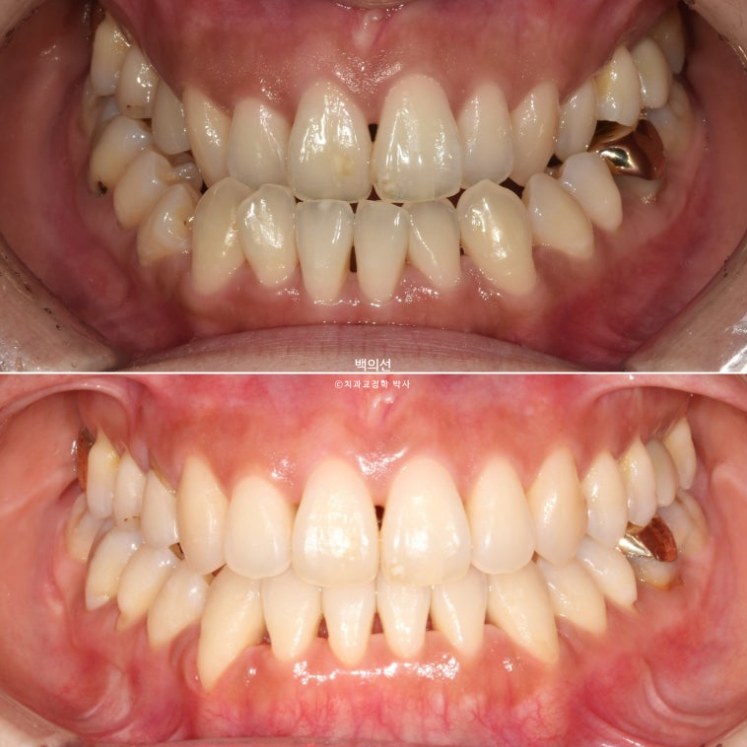 30대 비수술 비발치 주걱턱 부정교합 인비절라인 교정 관련 이미지 12