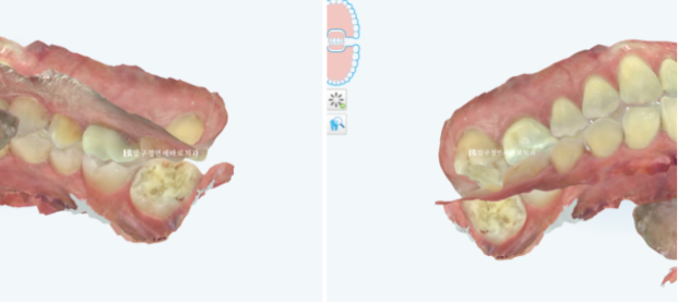40대 인비절라인 라이트 가위교합? 관련 이미지 7