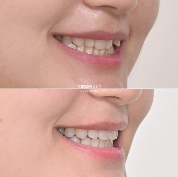 옥니 덧니 과개교합 반대교합 중심선 인비절라인 치료기간 1년 관련 이미지 19