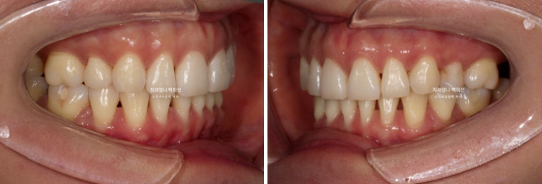 옥니 역교정 재교정 무턱 교정 치료기간 1년 10개월 관련 이미지 6