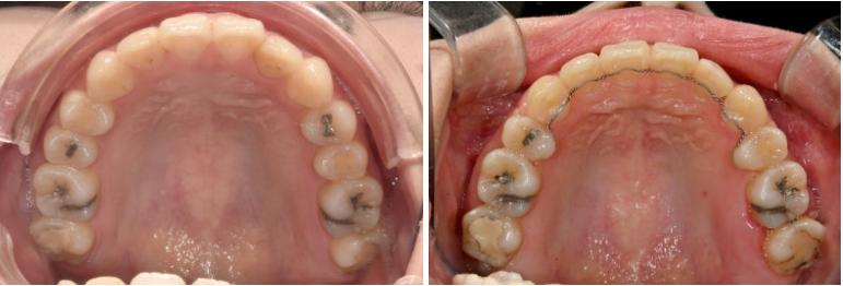 돌출입 인비절라인 발치교정 거미스마일 잇몸미소 잇몸돌출 입술부전증 무턱 재교정 관련 이미지 16