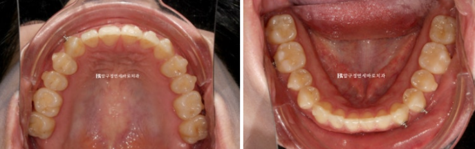 압구정 교정치과 / 옥니교정 인비절라인 라이트 덧니교정 관련 이미지 8