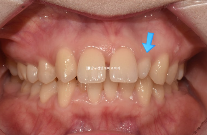 Actual Case of Treating Congenitally Missing and Peg-Shaped Teeth Without Implants image 2