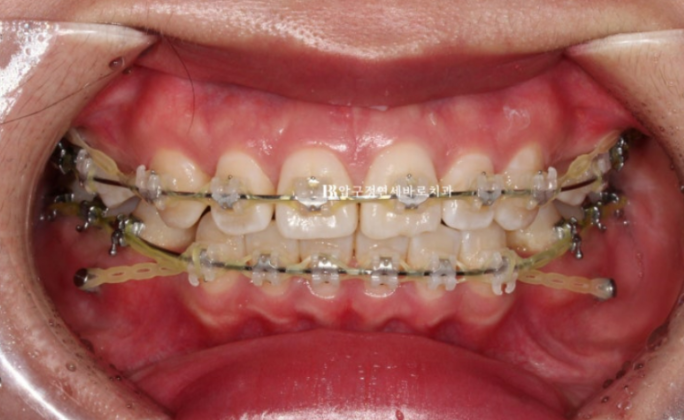 How Do the Buccal Corridors and Smile Line Change After Extraction Treatment for Protruding Teeth?|An Orthodontic Case That Also Improved Lip Incompetence image 5