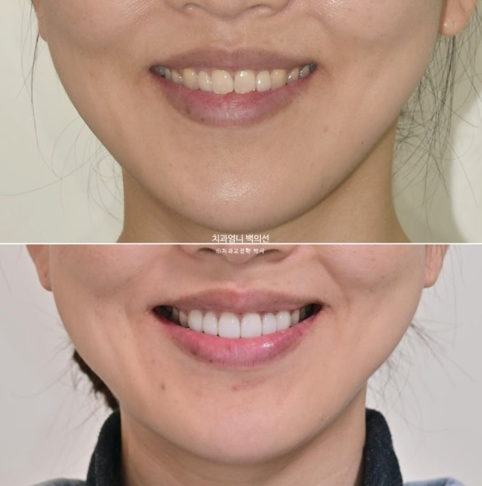 비수술 개방교합 클리피씨 30대 무삭제 라미네이트 치료기간 2년 관련 이미지 19