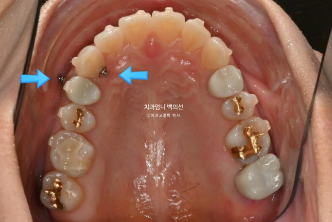 50대 치아교정 교합평면 기울어짐 토끼이 덧니 교정? 관련 이미지 6