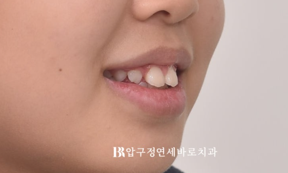 A Child’s Protruding Teeth Correction Review: Difficulty Closing the Lips image 4