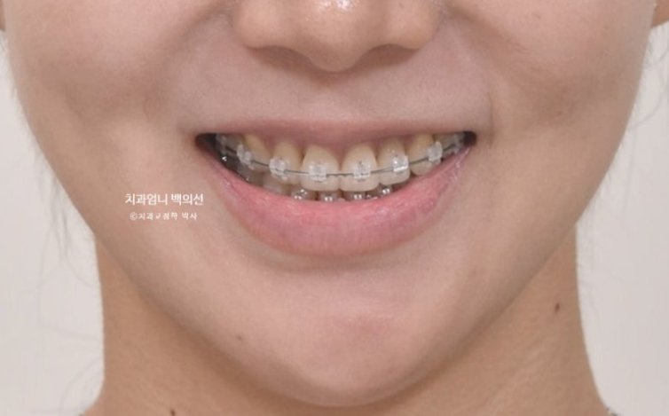 옥니 교정 역교정 재교정 무턱교정 치료기간 1년 10개월 관련 이미지 10