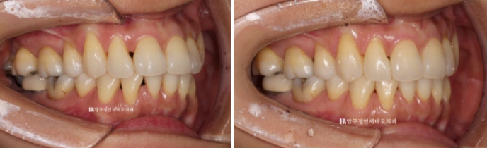 How Can Black Triangles Be Removed? Is Re-treatment Orthodontics an Option? image 7